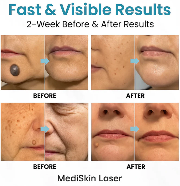 Mediskin Laser