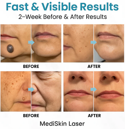 Mediskin Laser