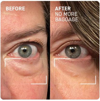 EYEUNDER™ Dark Circles & Bag Eye Cream