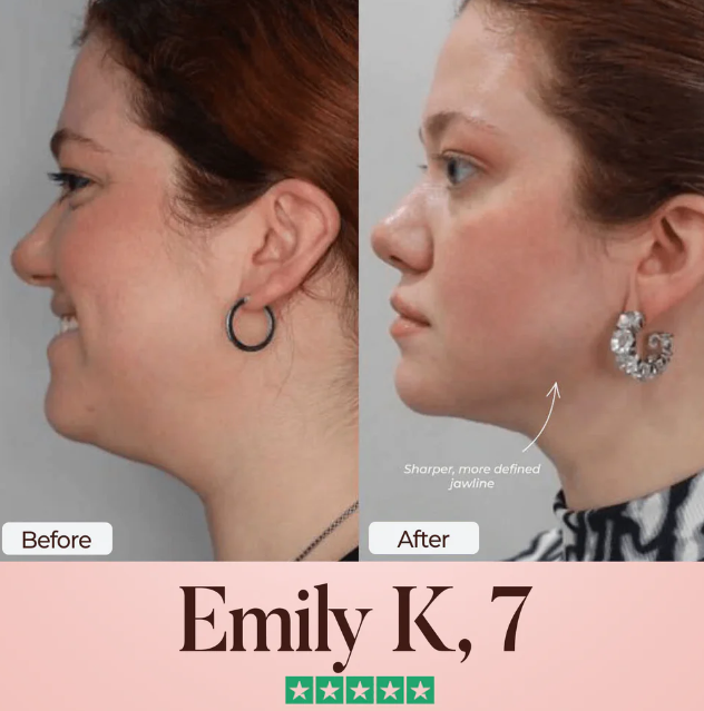 The cherieglow™ Lift : Infused with Retinol & Collagen to Reveal Your Best Jawline