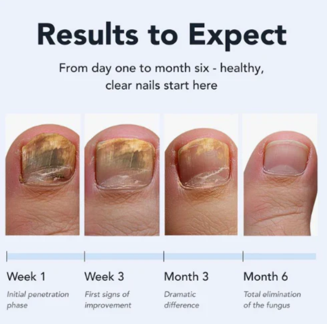 Kill Nail Fungus at the Root — Not Just the Surface