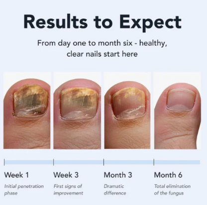 Kill Nail Fungus at the Root — Not Just the Surface
